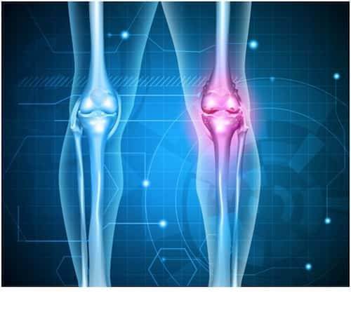 Sự khách biệt của khớp bình thường và khớp bị thoái hóa.