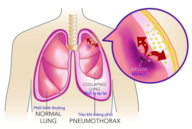 Ung thư phổi- Mầm mống nguy hiểm ngầm
