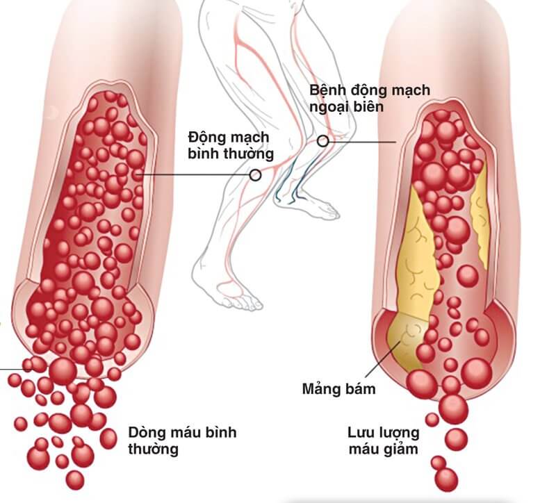Nước Kangen có thể hỗ trợ điều trị bệnh tim mạch?